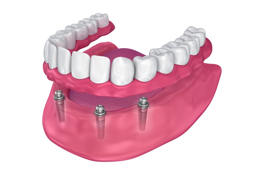 インプラントオーバーデンチャー