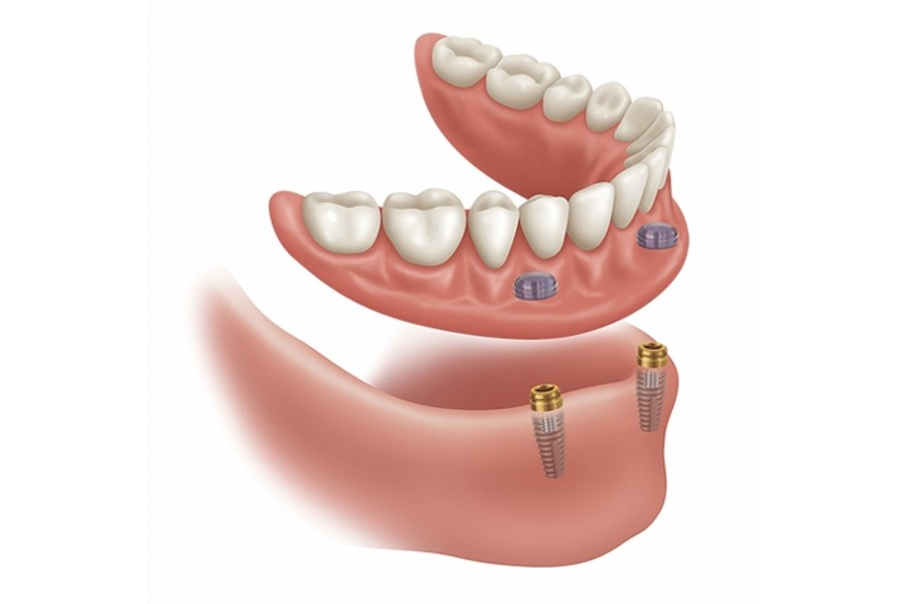 マグネット型の義歯